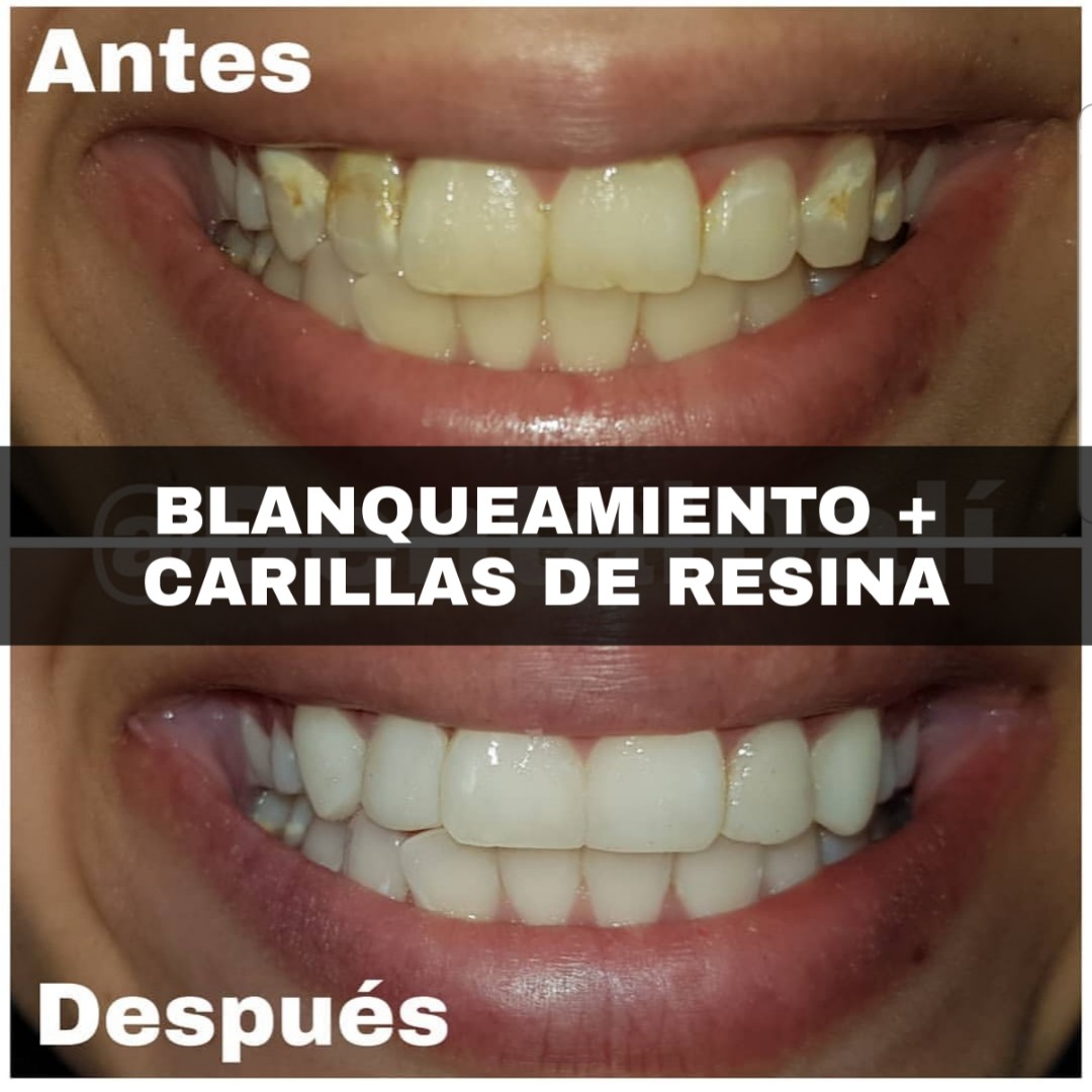 Protesis fija sobre implantes