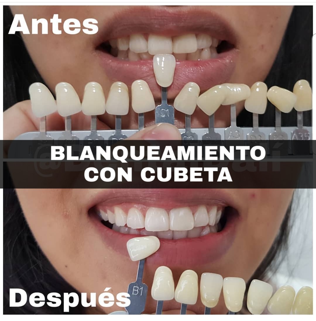 blanqueamiento