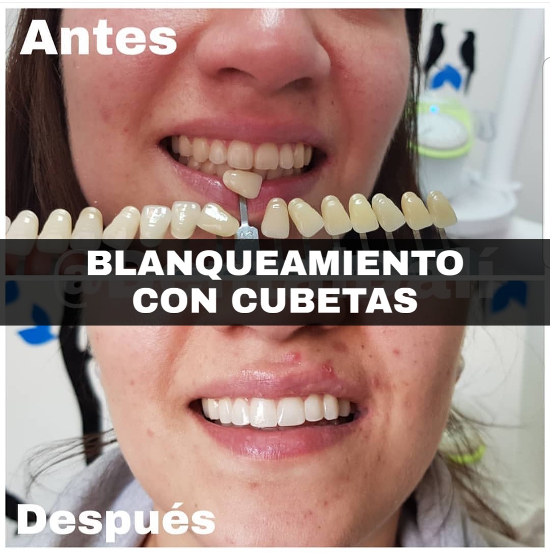 blanqueamiento