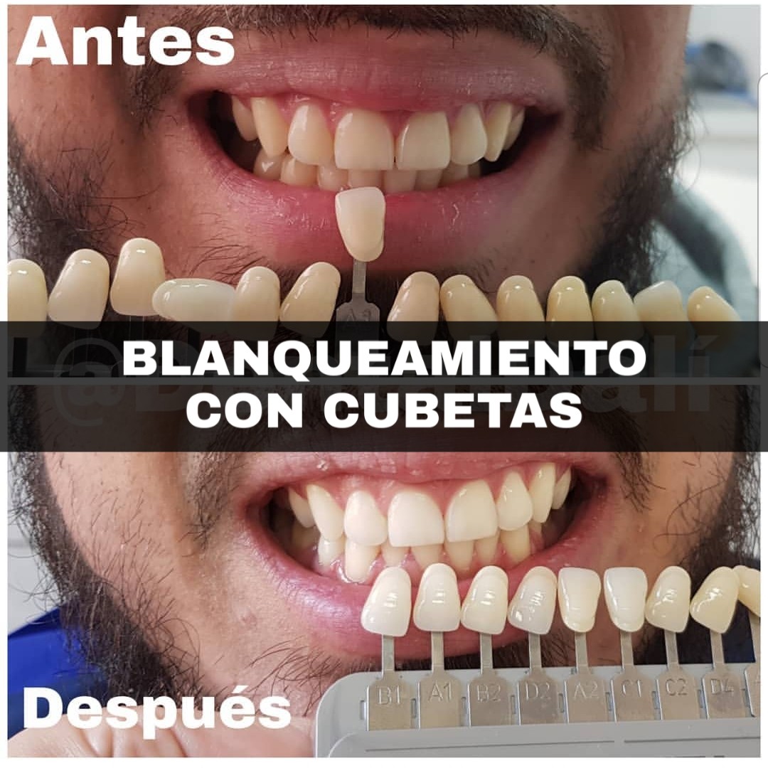 blanqueamiento