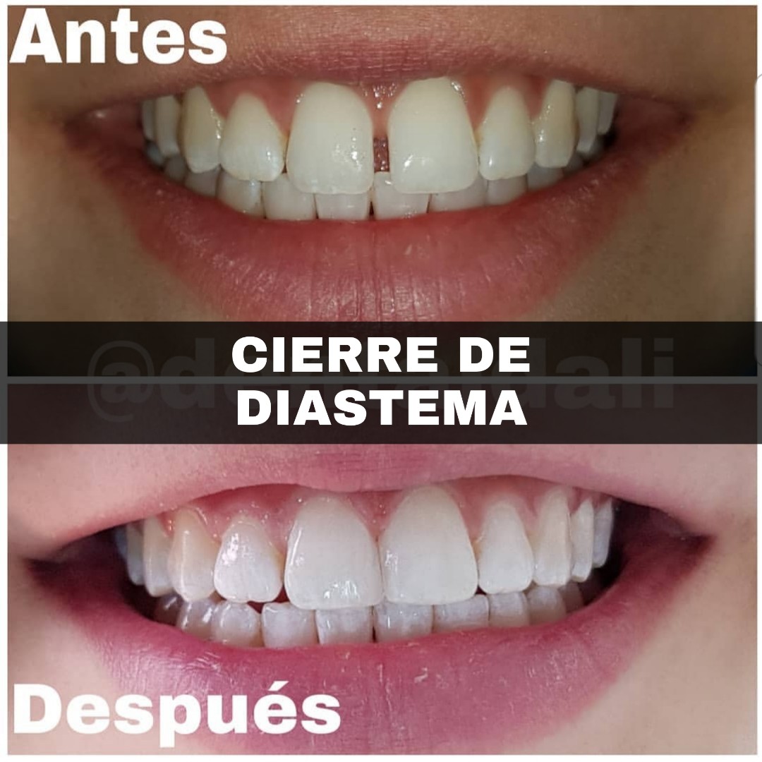 Diseño de sonrisa perfecta