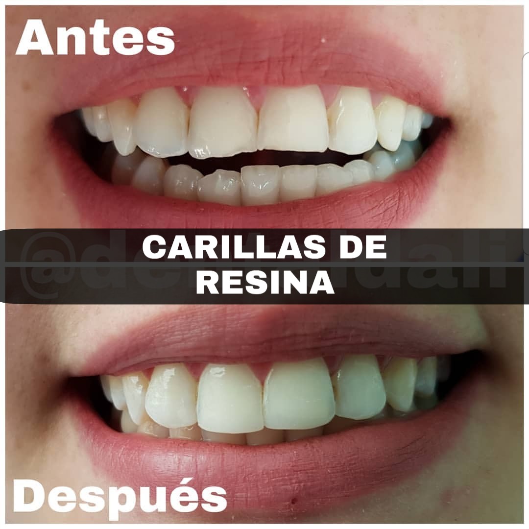 Limpieza dental + desmanchado