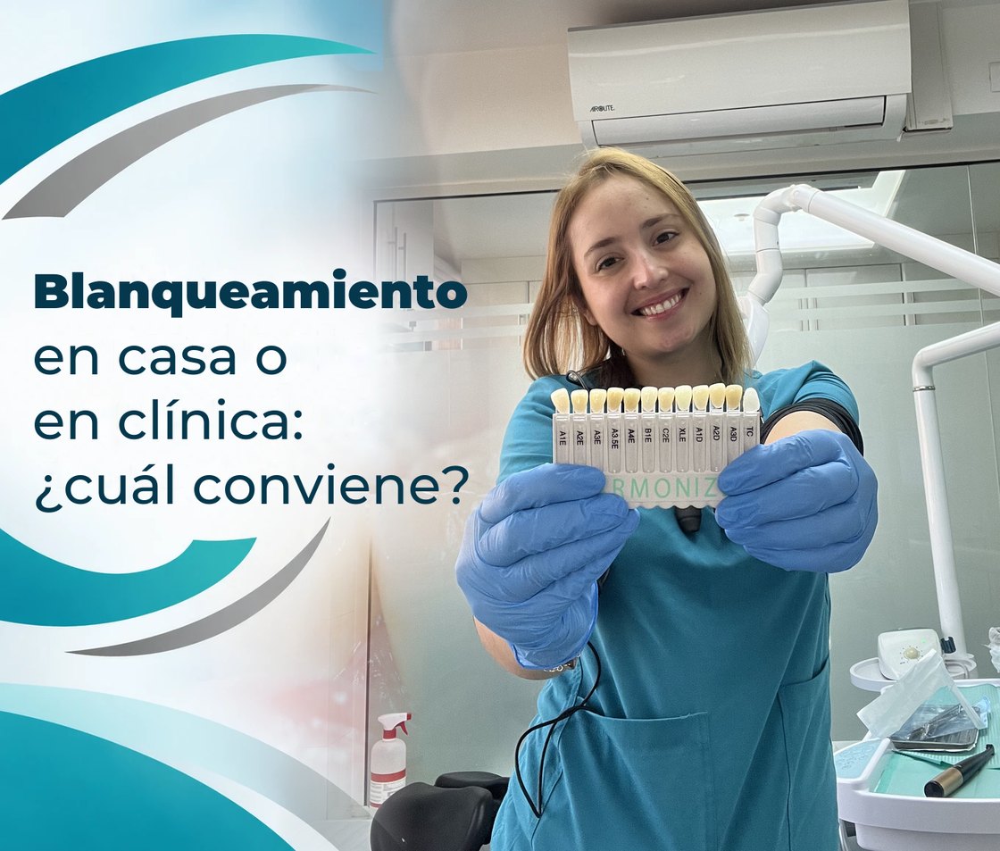Blanqueamiento dental en casa o en clínica: ¿cuál conviene?