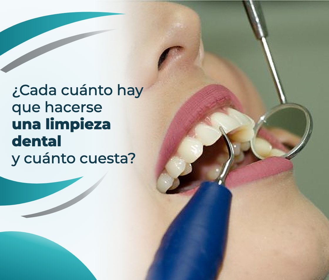 ¿Cada cuánto hay que hacerse una limpieza dental y cuánto cuesta?