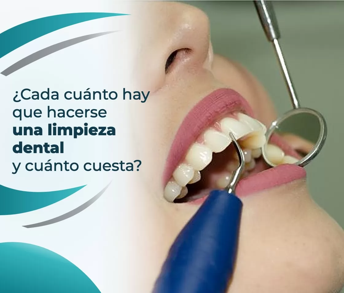 ¿Cada cuánto hay que hacerse una limpieza dental y cuánto cuesta?