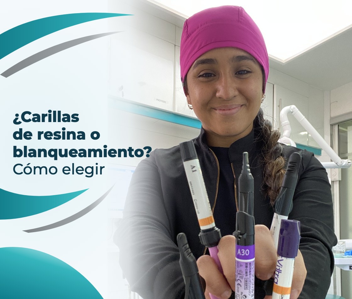 ¿Carillas de resina o blanqueamiento? Cómo elegir