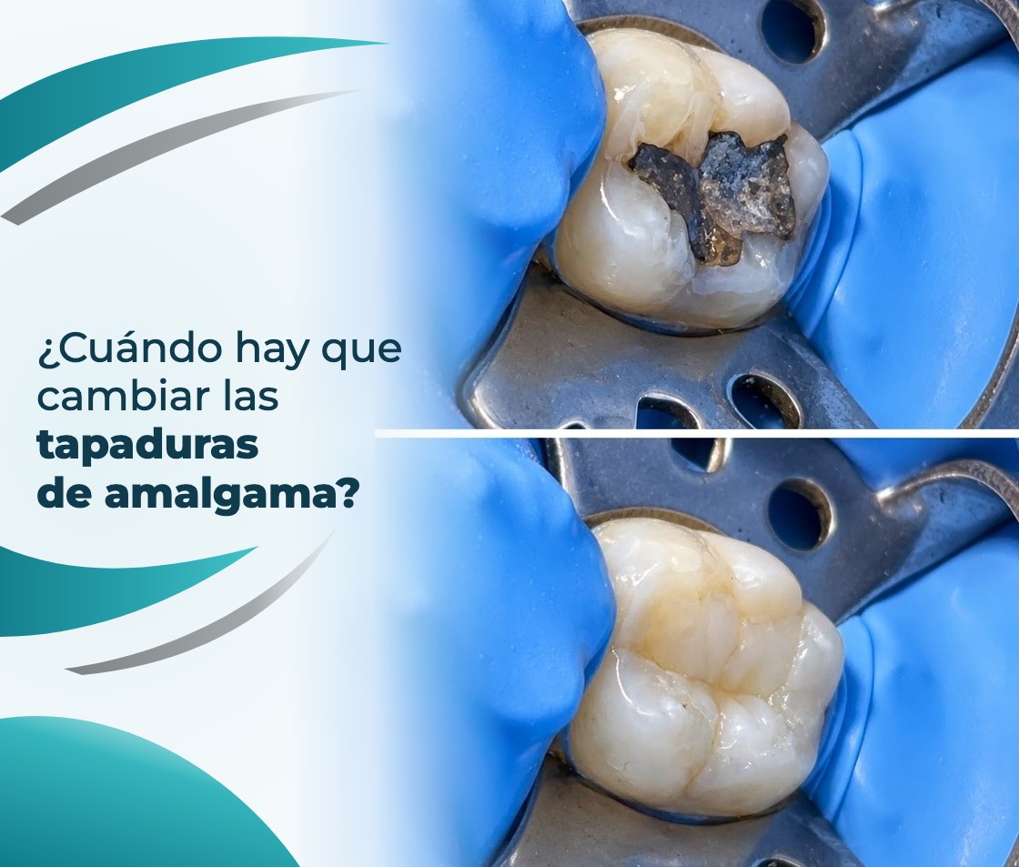 ¿Cuándo hay que cambiar las tapaduras de amalgama?