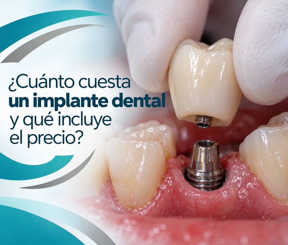 ¿Cuánto cuesta un implante dental y qué incluye el precio?