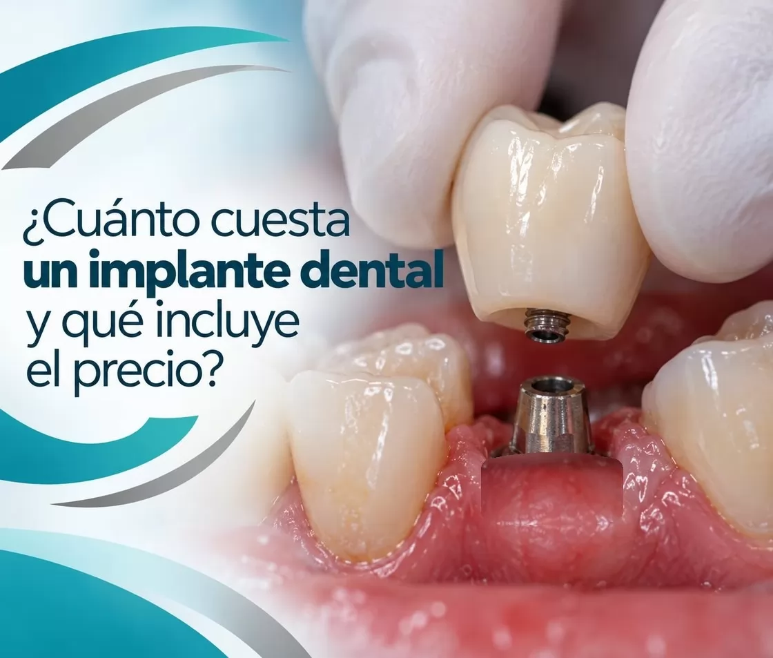 ¿Cuánto cuesta un implante dental y qué incluye el precio?