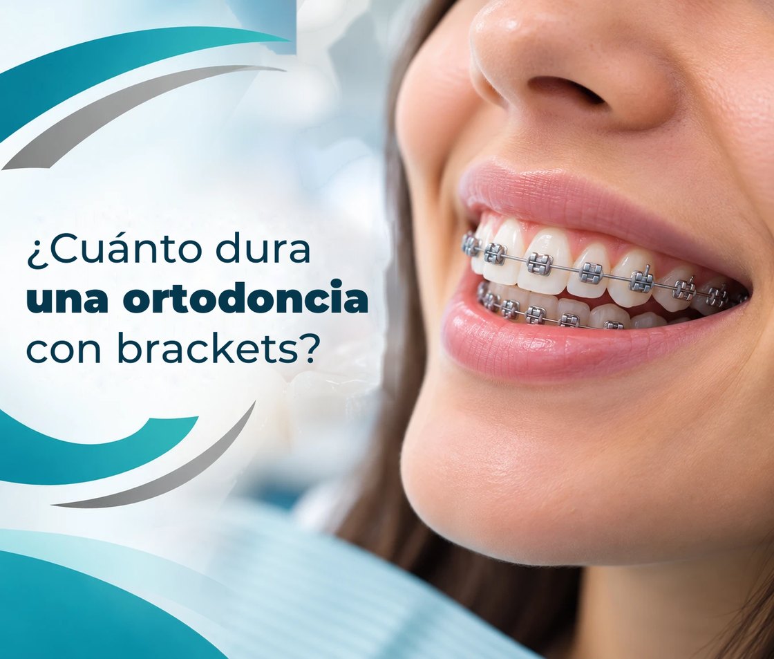 ¿Cuánto dura una ortodoncia con brackets?