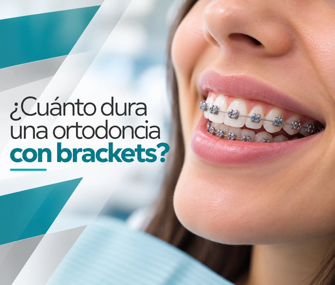 ¿Cuánto dura una ortodoncia con brackets?