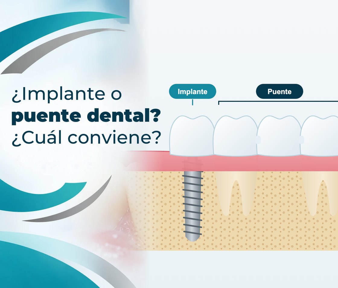 ¿Implante o puente dental? Cuál conviene para reemplazar un diente
