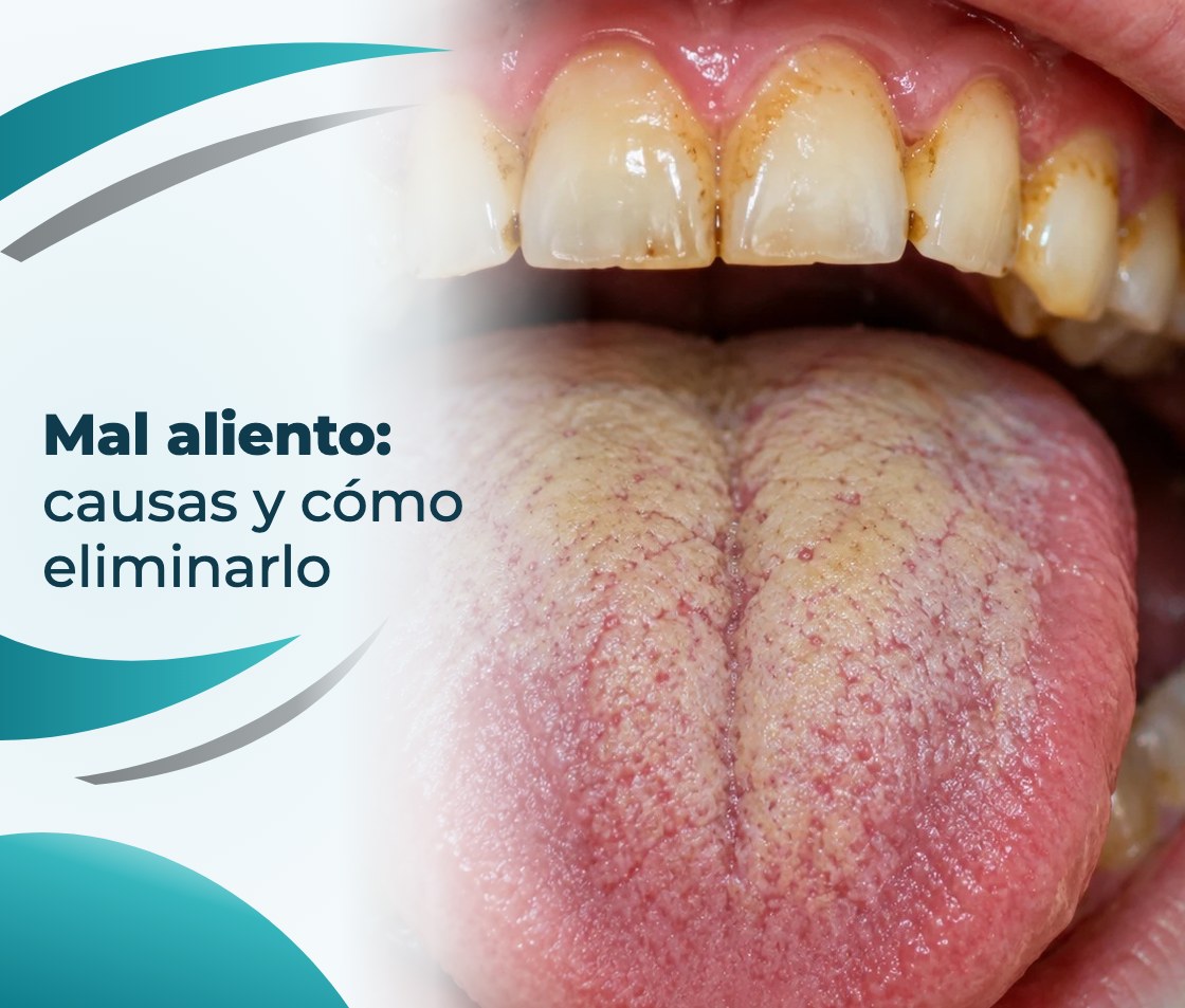 Mal aliento: causas y cómo eliminarlo
