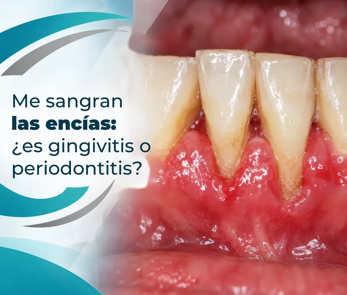 Me sangran las encías: ¿es gingivitis o periodontitis?
