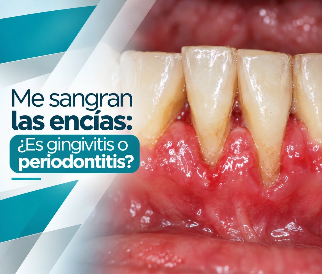 Me sangran las encías: ¿es gingivitis o periodontitis?