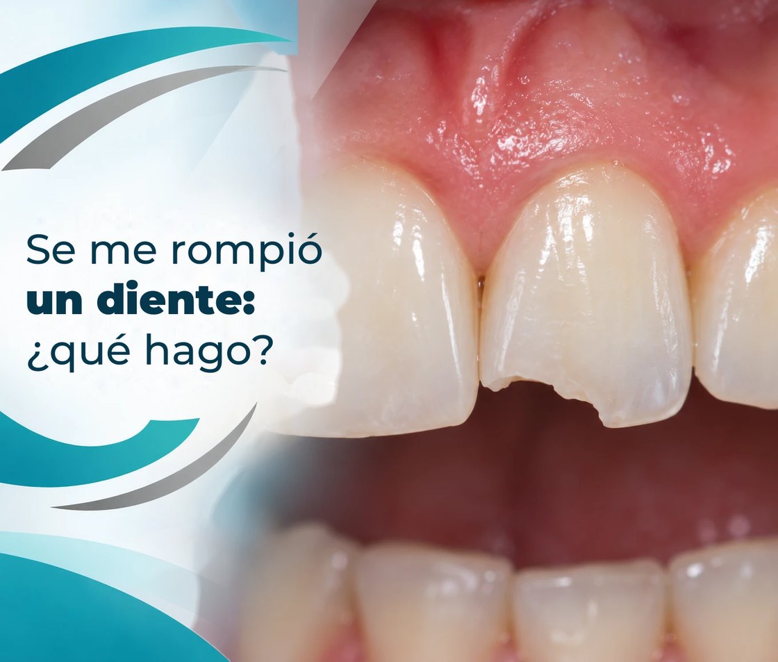Se me rompió un diente: ¿qué hago?