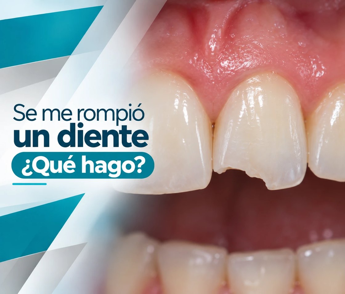 Se me rompió un diente: ¿qué hago?