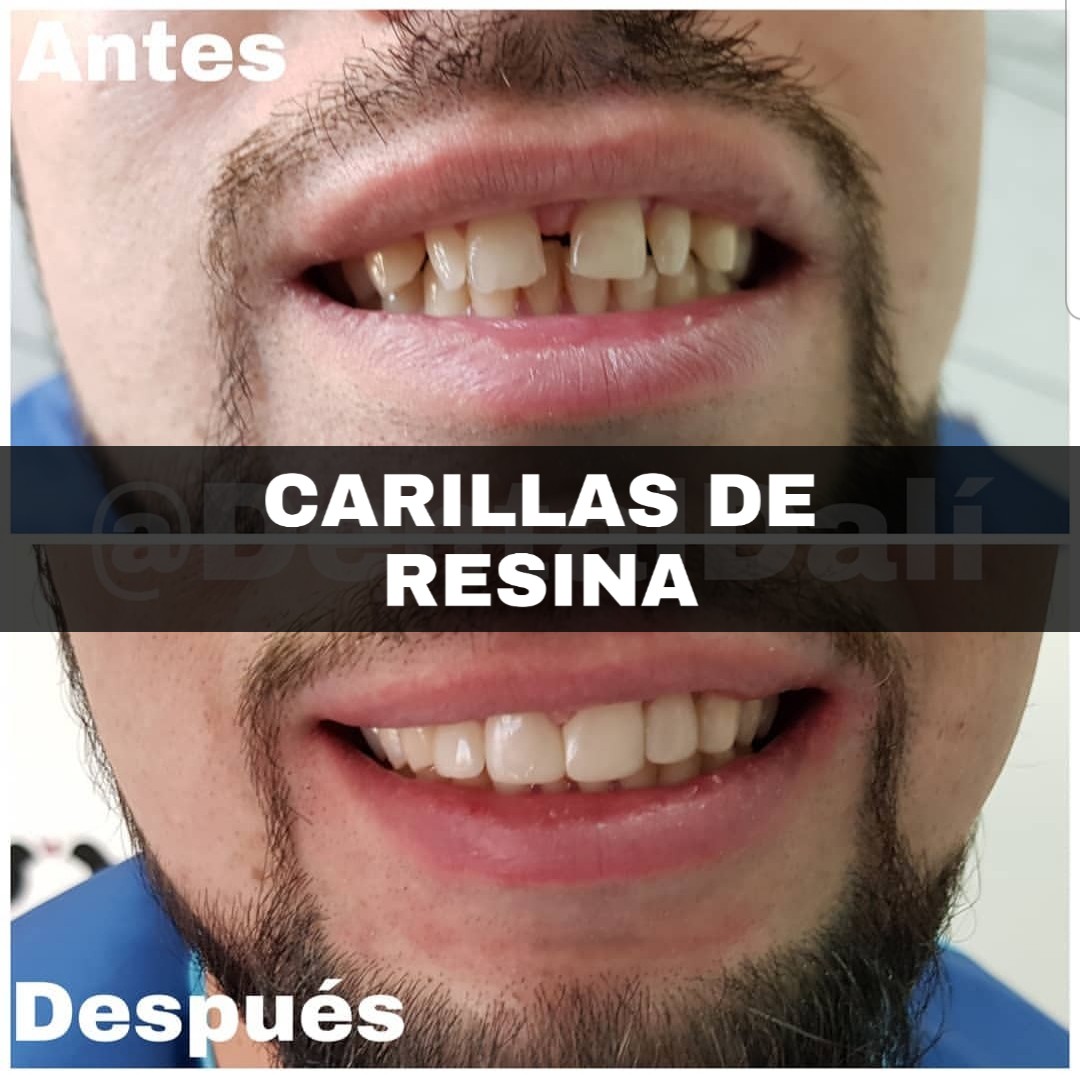 Carillas de Resina