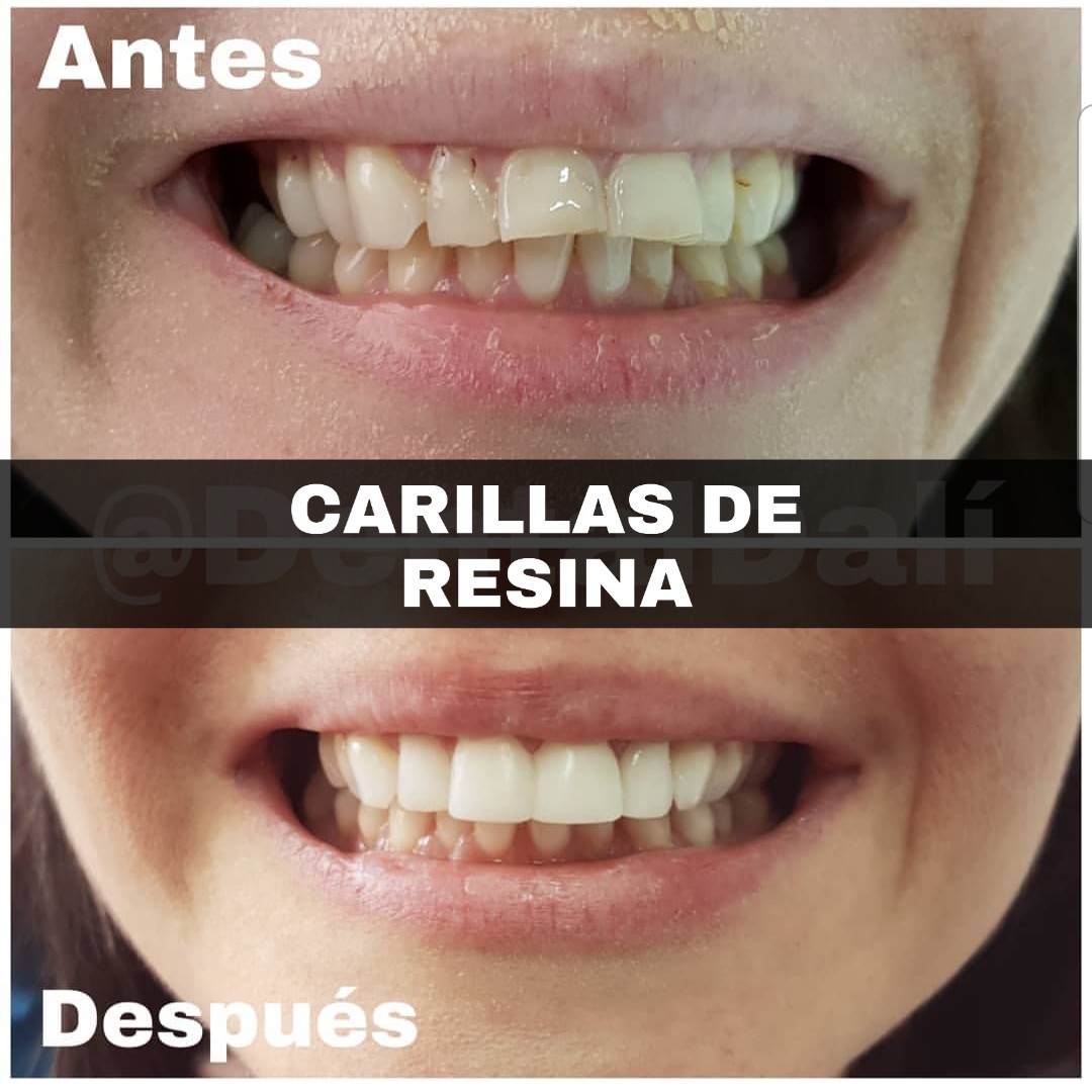 Carillas de Resina