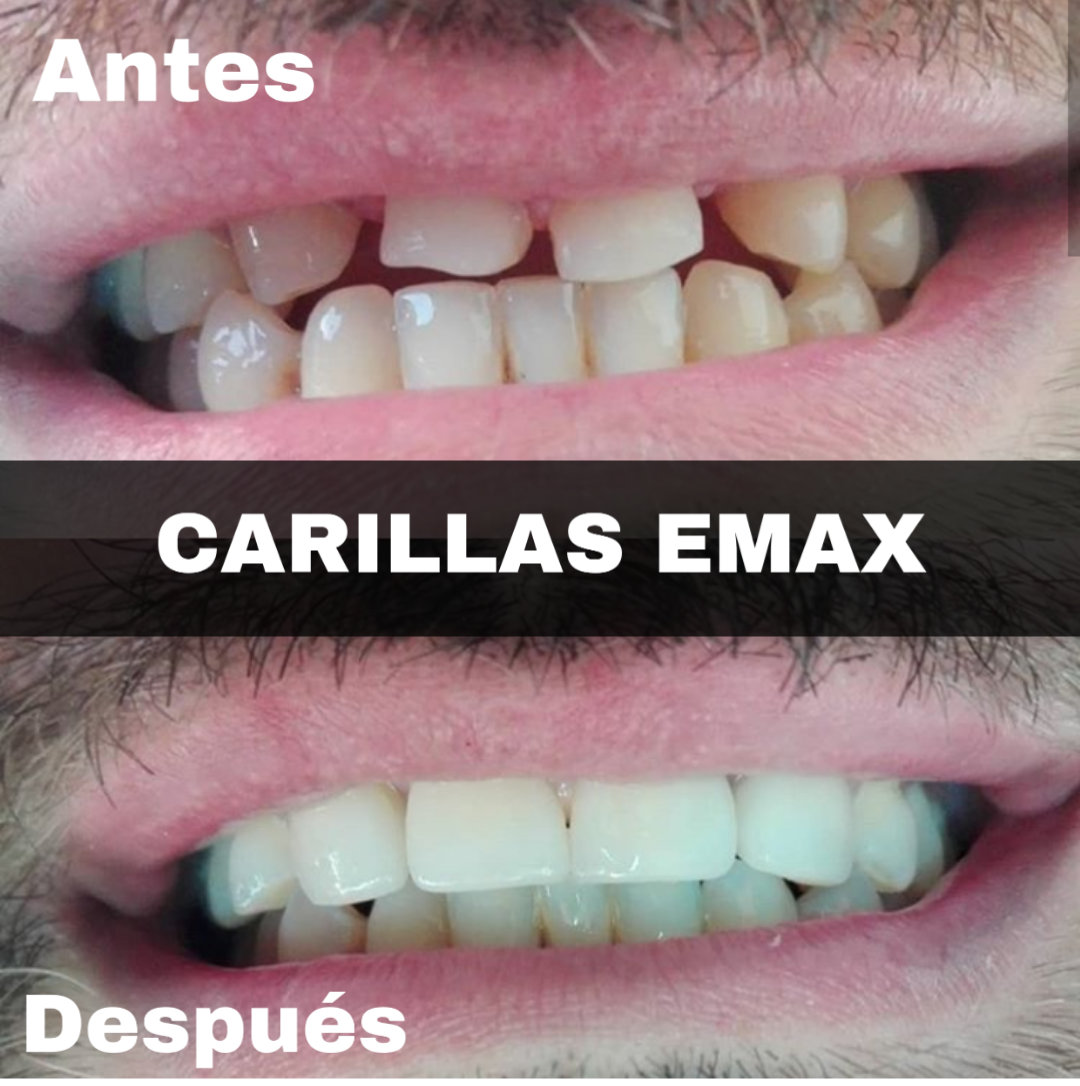 Carillas de Resina