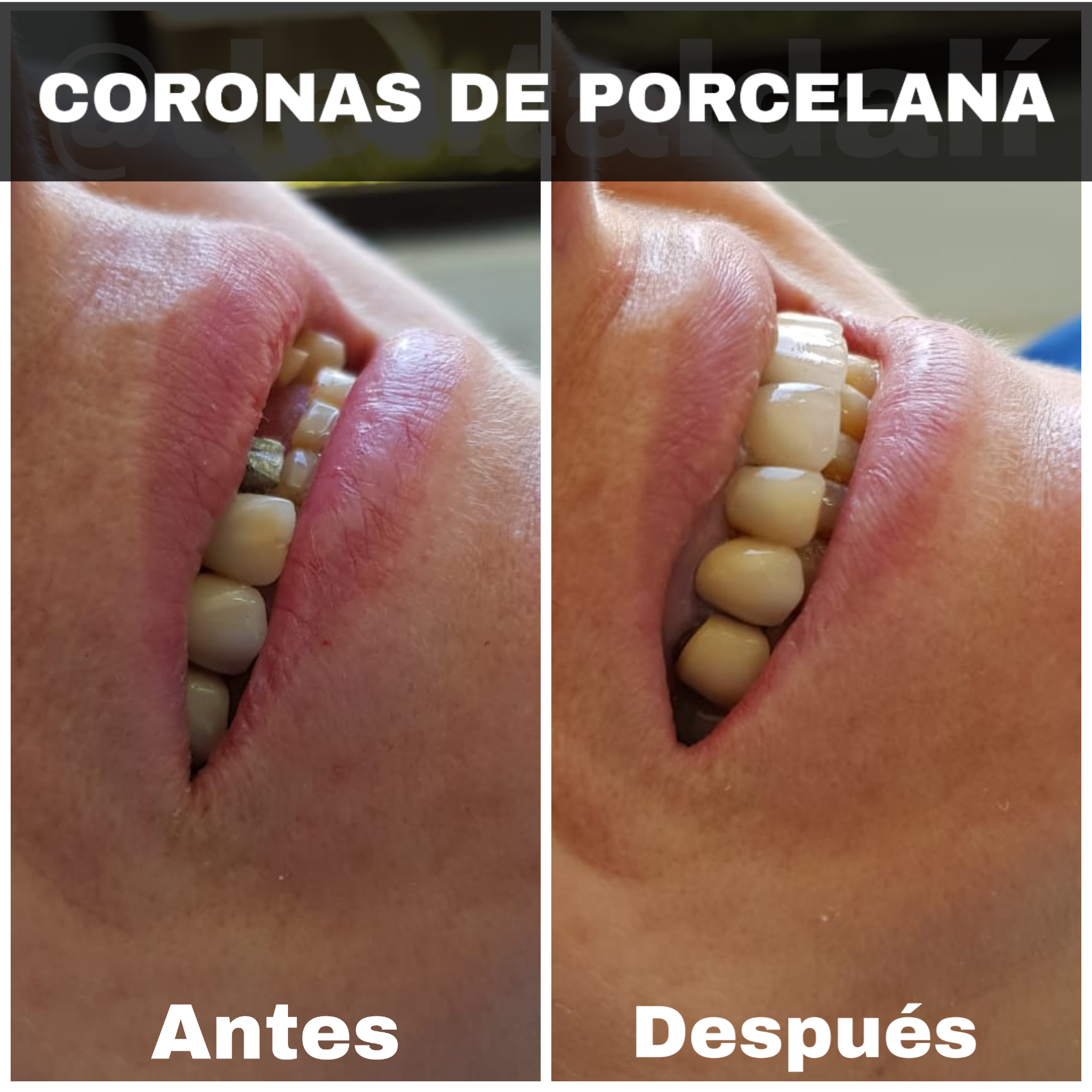 Coronas de Porcelana