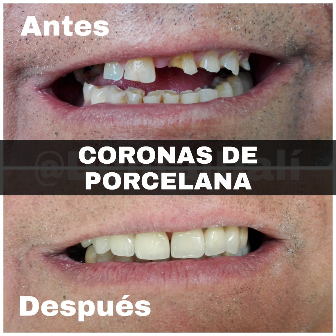 Coronas de Porcelana