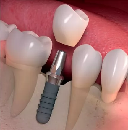 Implantes Dentales y Rehabilitación sobre Implantes en Clínica Dental Dalí, La Florida
