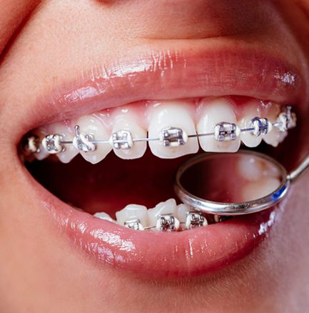 Ortodoncia y Alineadores Invisibles en Clínica Dental Dalí, La Florida