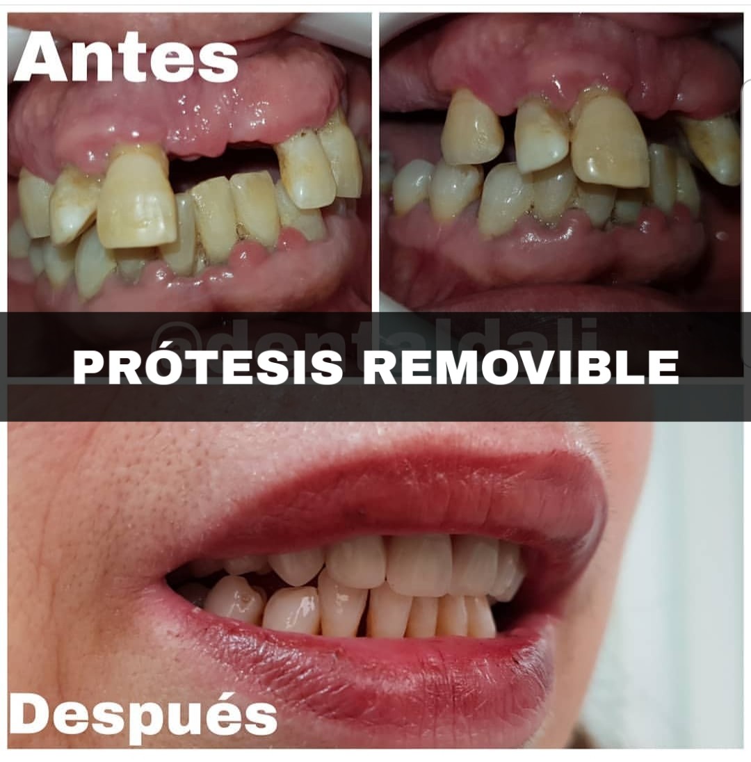 Protesis Removible