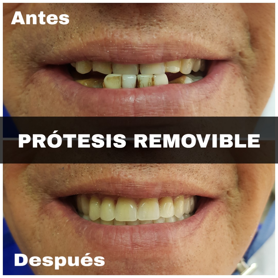 Protesis Removible