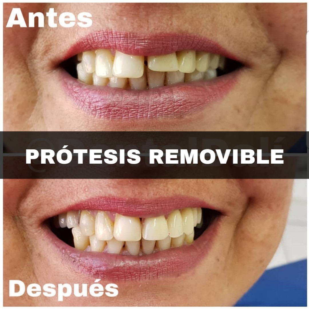 Protesis Removible