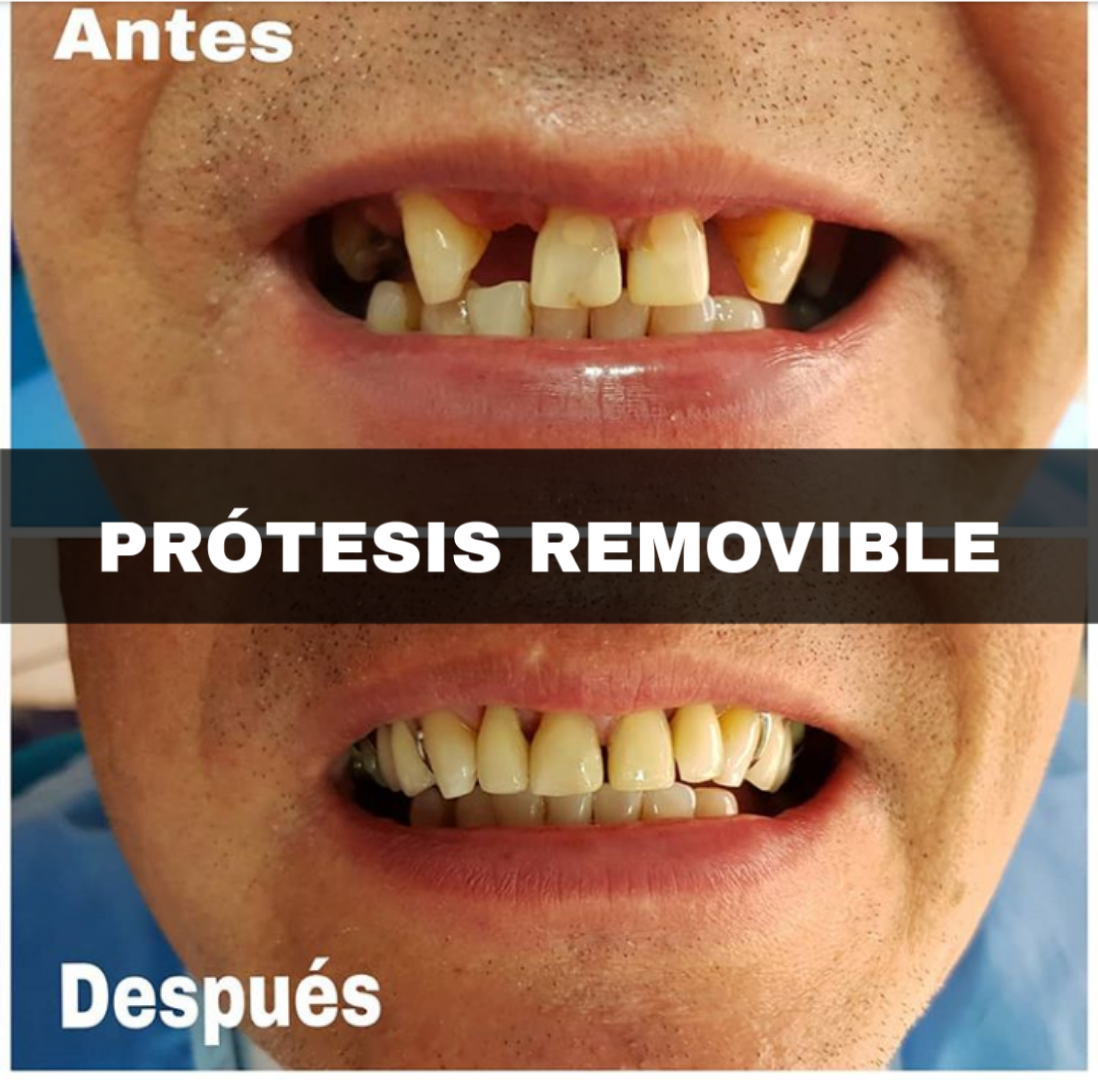 Protesis Removible