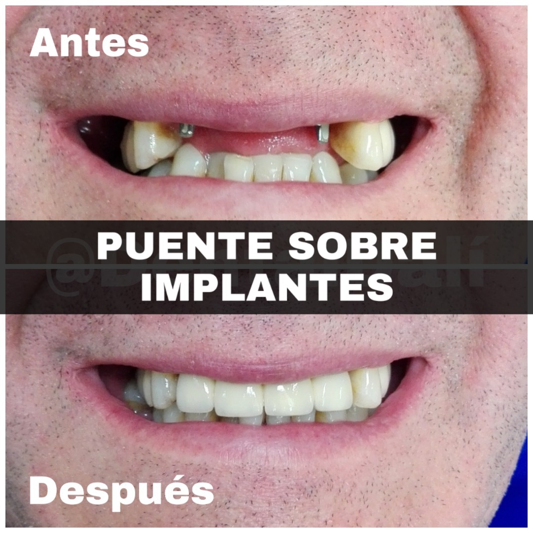 Puentes sobre Implantes