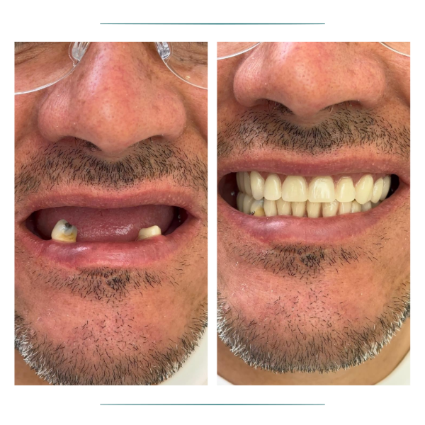 Rehabilitación Oral y Alta Complejidad en Clínica Dental Dalí, La Florida